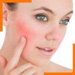 Lumimax rosacea