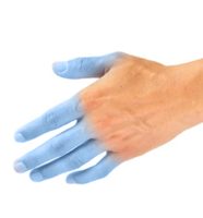 Depilación Láser Dedos De La Mano. 6 SESIONES