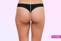 ANTI CELULITIS - Masaje Manual . 6 SESIONES