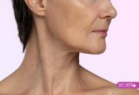 VELASHAPE Facial - Rejuvenecedor Papada. 8 SESIONES